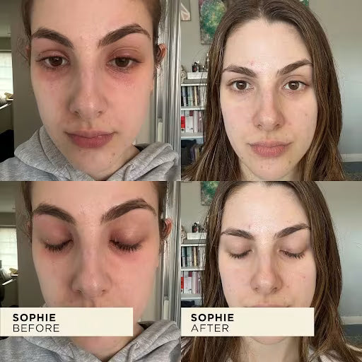 Before and after comparison of a person with text labels 'SOPHIE BEFORE' and 'SOPHIE AFTER'.