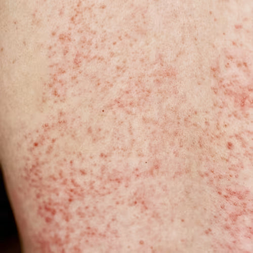 Close-up of inflamed agitated rash.