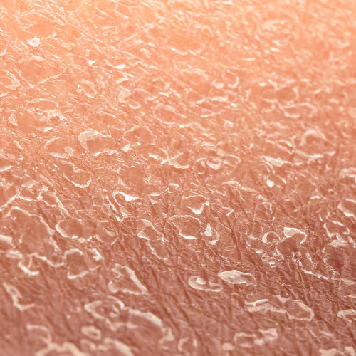 Dry close-up of eczema like skin