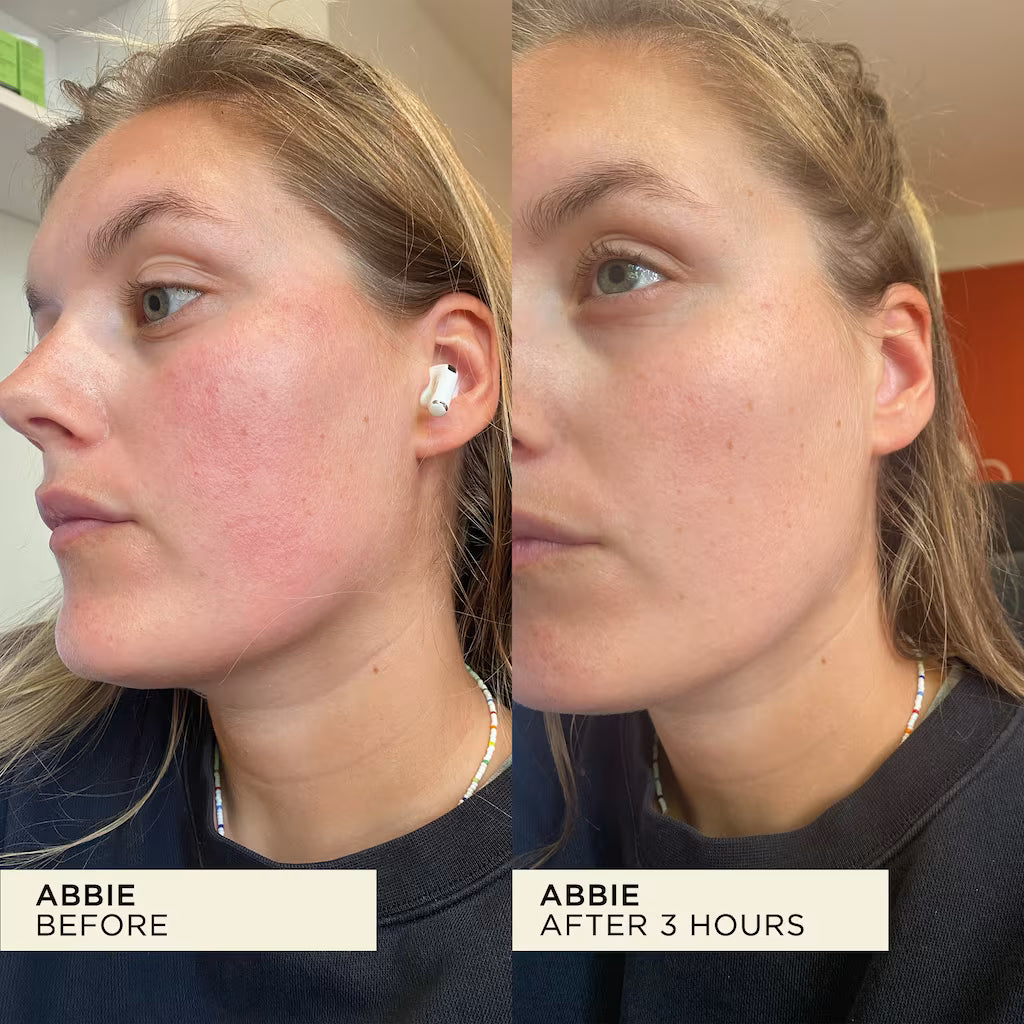 Inflammation on face before and after cleared up after just three hours of using WONDERBALM