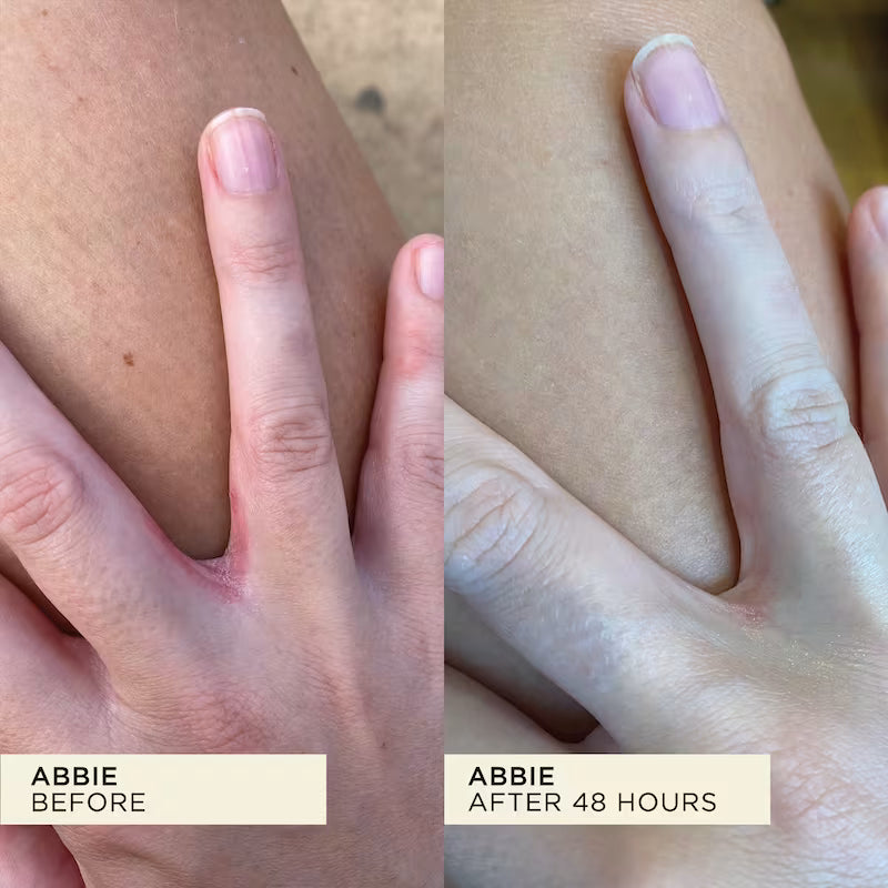 Before and after comparison of a hand with visible redness cleared up