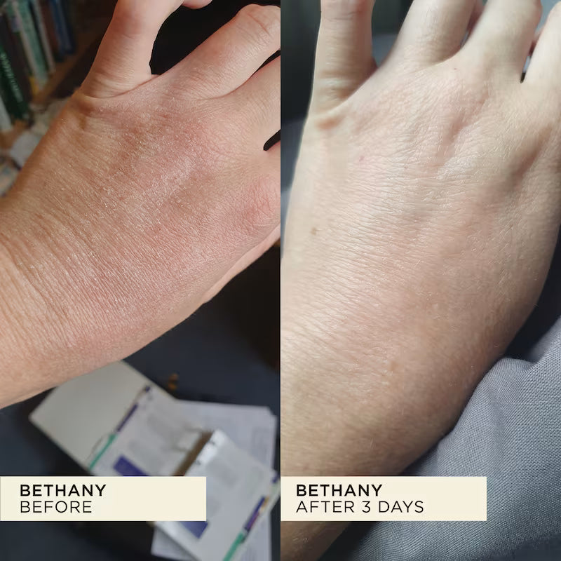 Dry. eczema skin on hand completely healed after three days of using WONDERBALM