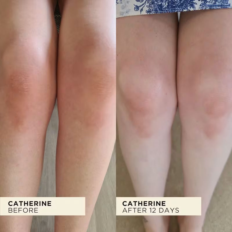 Before and after comparison of a person's legs with visible dry areas on the knees having improved drastically.