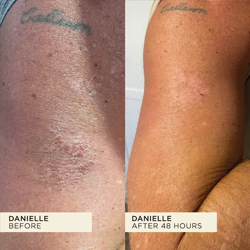 Problematic scaling skin on arm fully healed and hydrated after using WONDERBALM