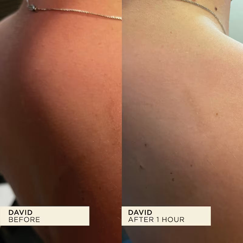 Before and after comparison of David's back with visible sunburn.