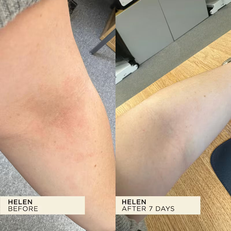 Dry rash area on inside of arm healed after a week of using WONDERBALM.