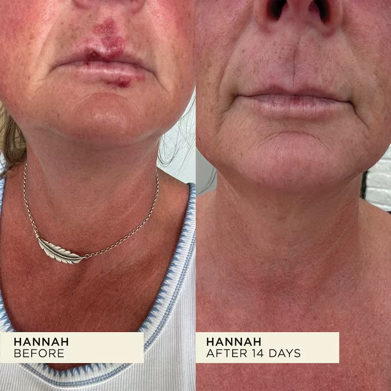 Before and after comparison of a person's face with visible skin improvements.