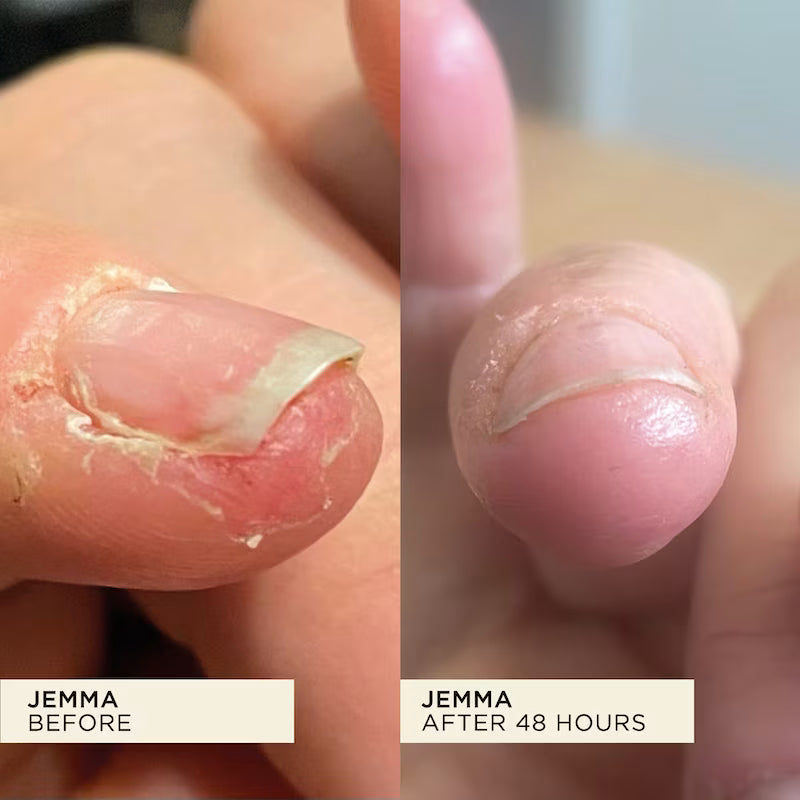 Sore, dry and peeled skin around the fingertip almost healed completely after two days.