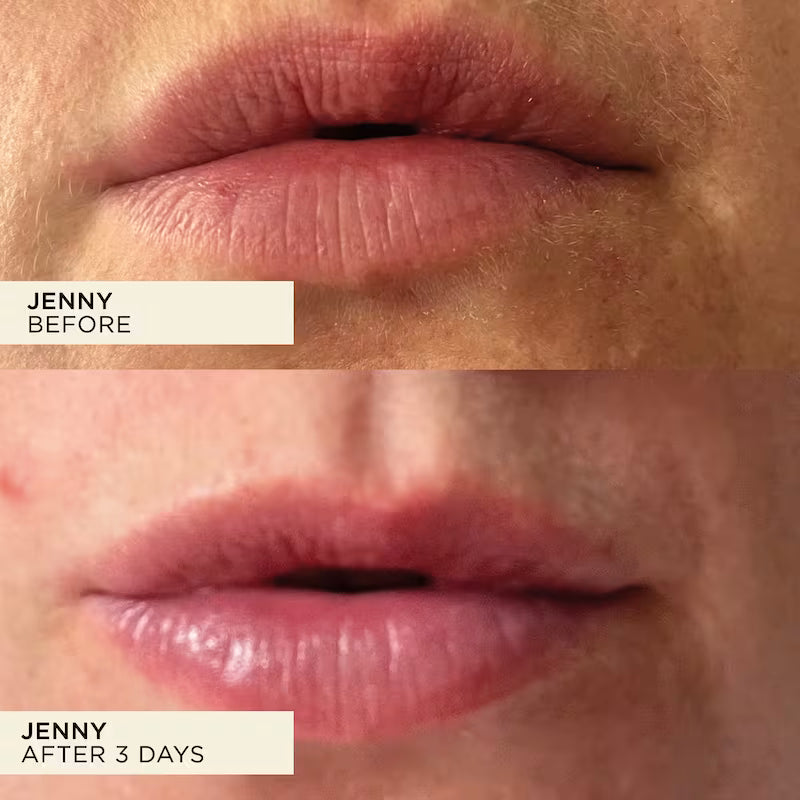 Jenny's dry and sore lips looking more hydrated before and after