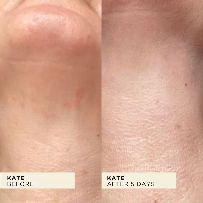 Before and after comparison of WONDERBALM used on the neck - reduced redness 