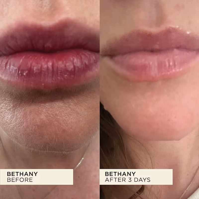Sore, cracked lips before and after review of WONDERBALM showing completely healed lips after 3 days