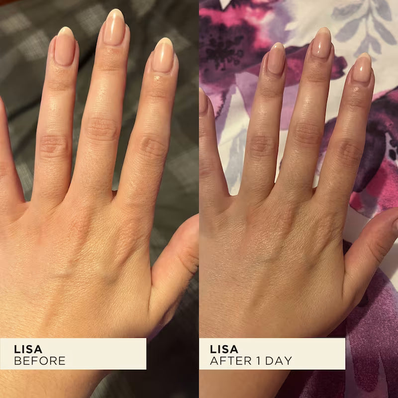 Before and after comparison of Lisa's hand