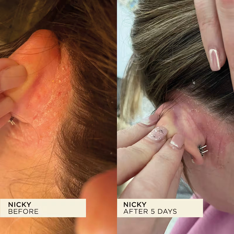 Dry, troubled eczema skin behind ear calmed and improved.