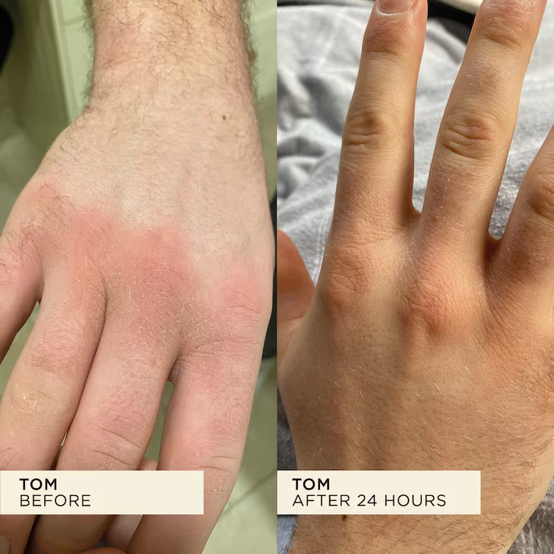 Before and after comparison of a hand with a rash completely cleared in 24 hours.
